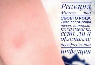 Повышение температуры после манту