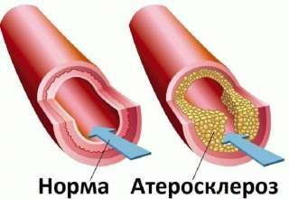 Симптомы атеросклероза